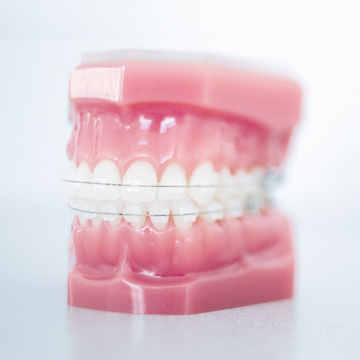 Tooth-coloured Braces
